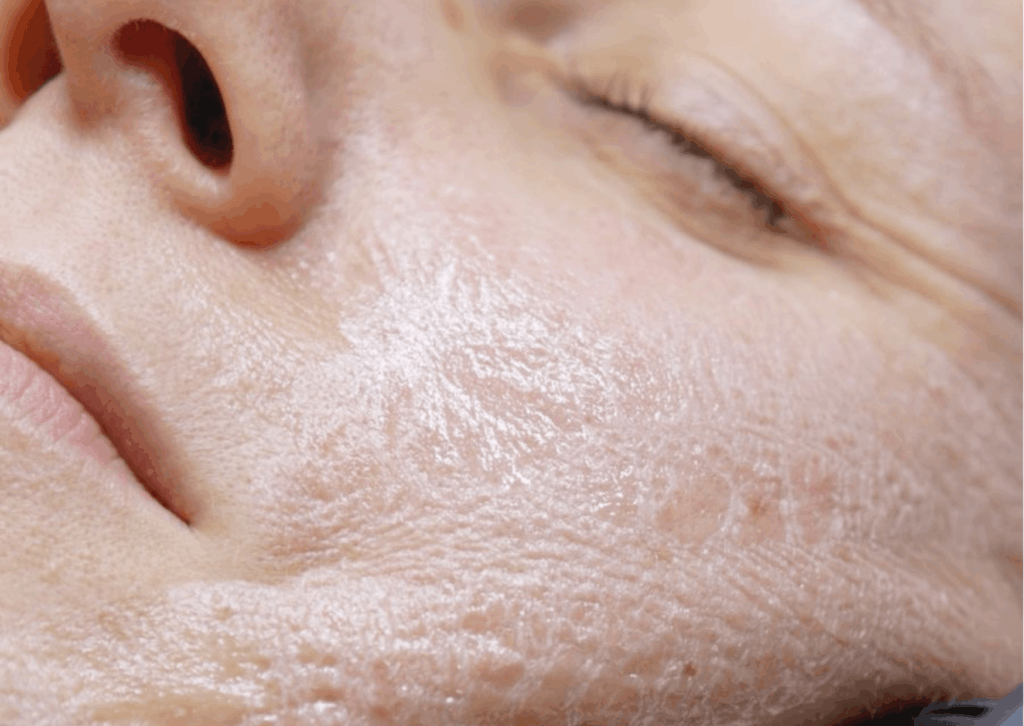 Peeling na rozszerzone pory z wykorzystaniem peelingu dyniowego Dermaquest