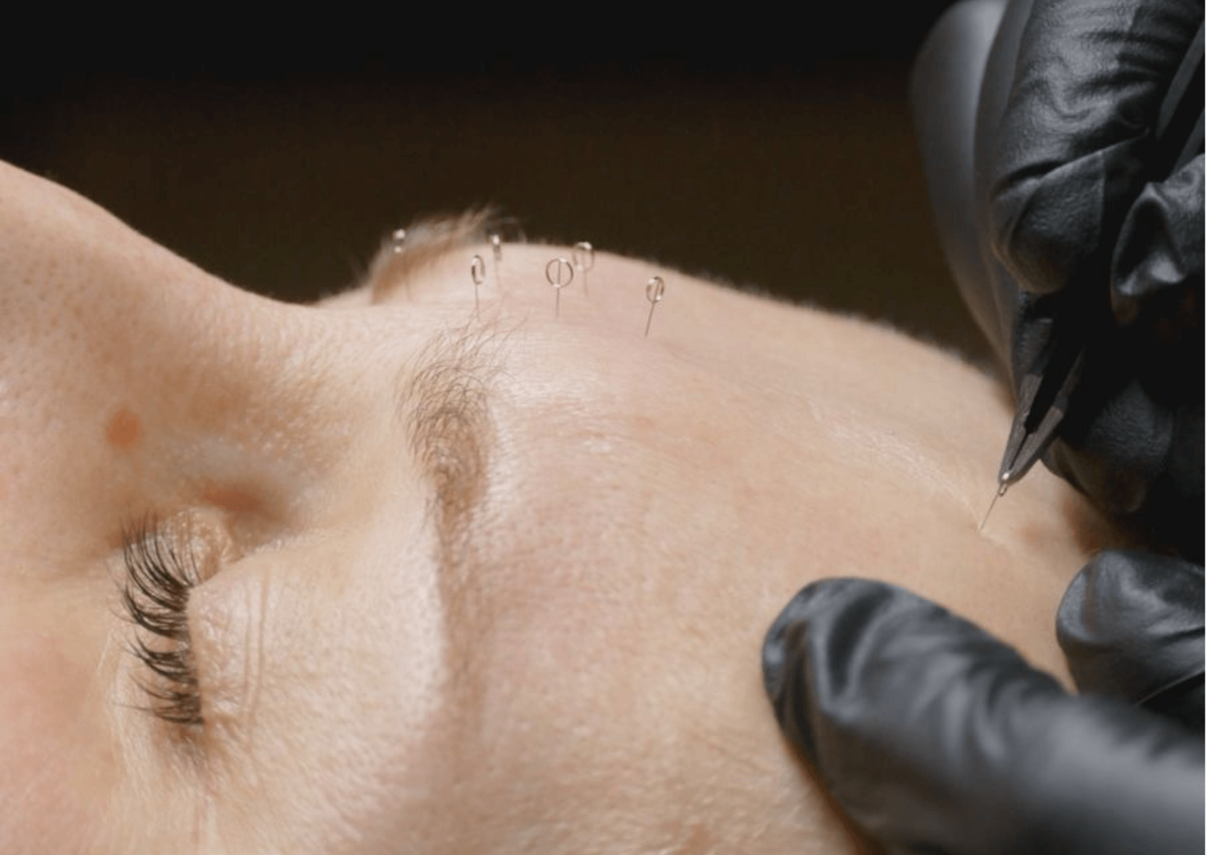 Intradermal needling podczas zabiegu na twarz